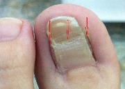 Осложнения после операции по поводу вросшего ногтя с помощью лазера (рецидив с двух сторон и деформация ногтя)