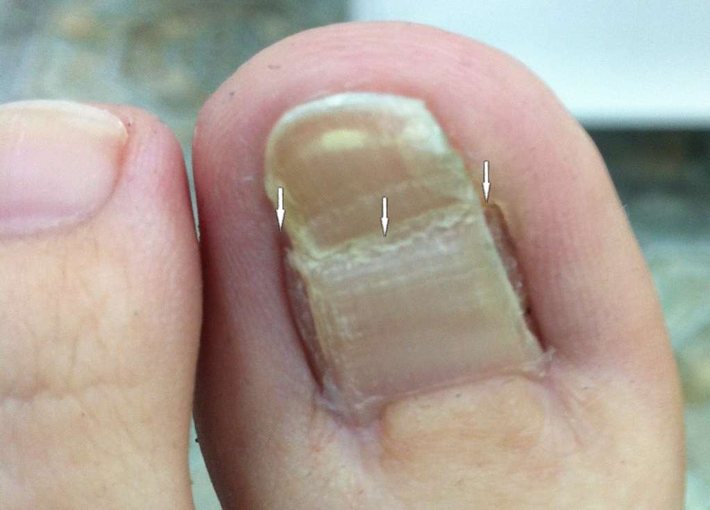Осложнения после операции вросшего ногтя