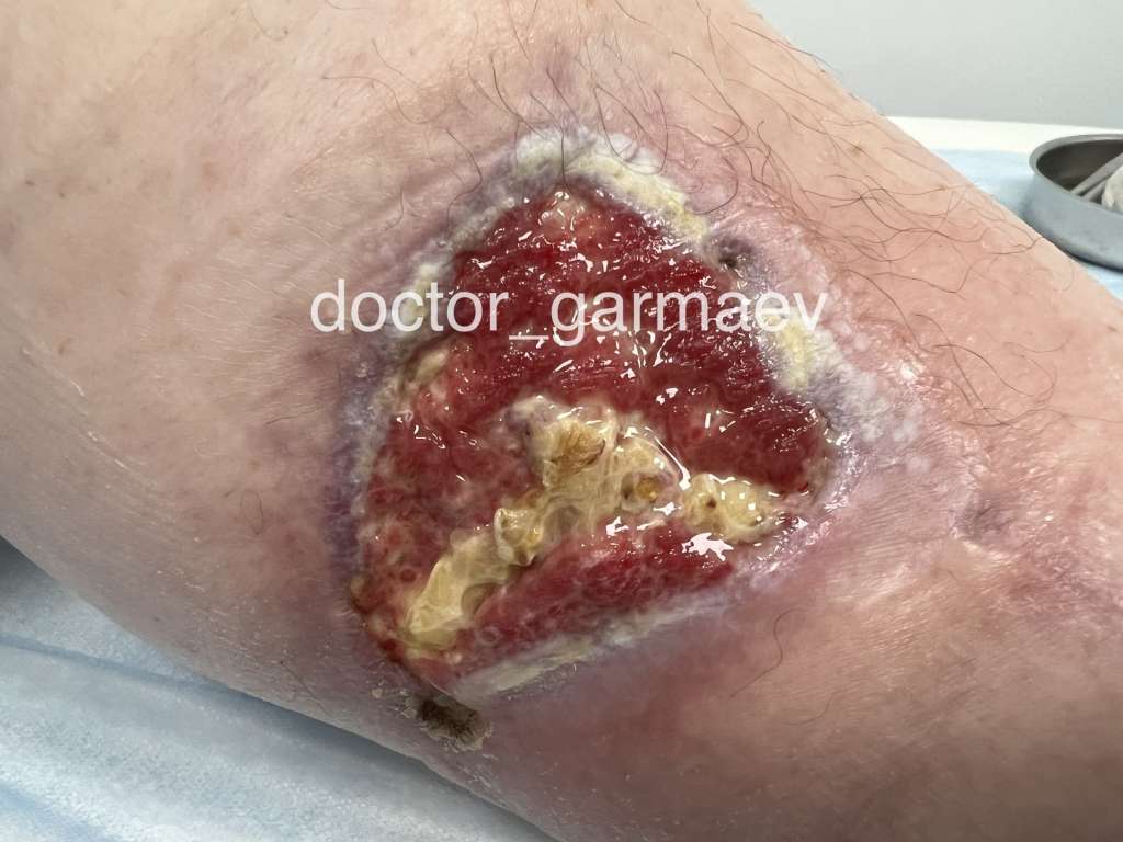 Осложненная рана после онкологической операции. Лечение