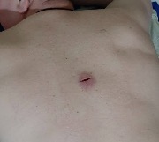 Атерома на спине после операции