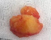 Липома после удаления. Липоматоз. #липома #липоматоз