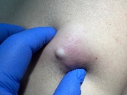 Нагноившаяся атерома