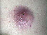 Ateroma.-Nagnoenie.-Foto