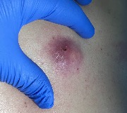 Нагноившаяся атерома