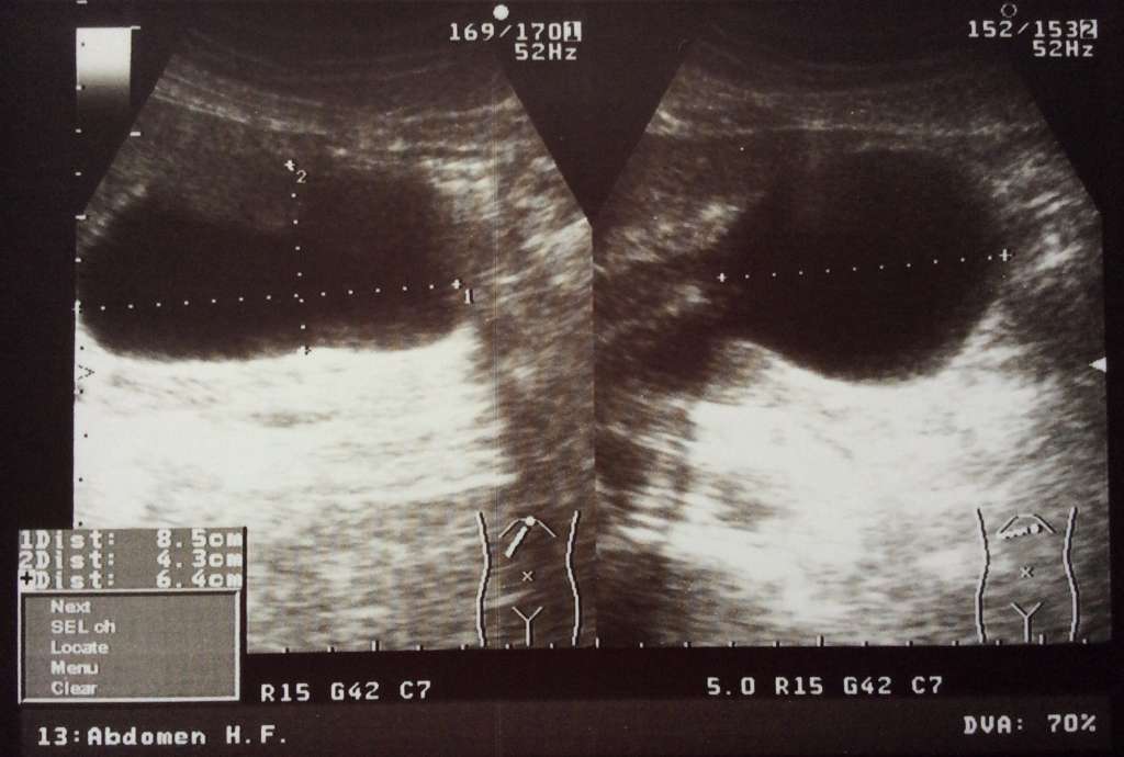 УЗИ псевдокиста поджелудочной железы