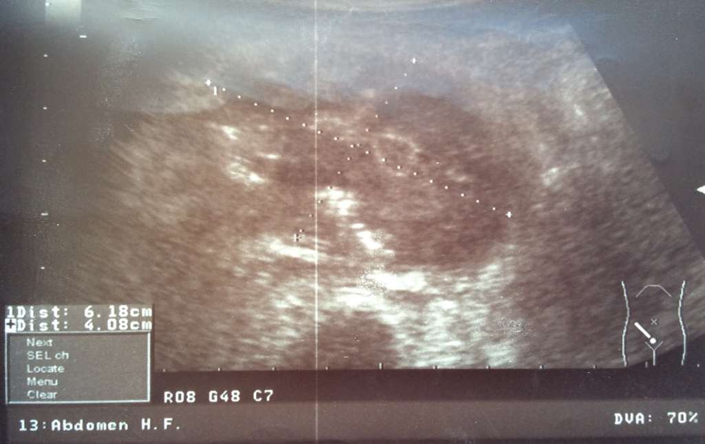 УЗИ абсцесс брюшной полости (ретроцекальный).jpg