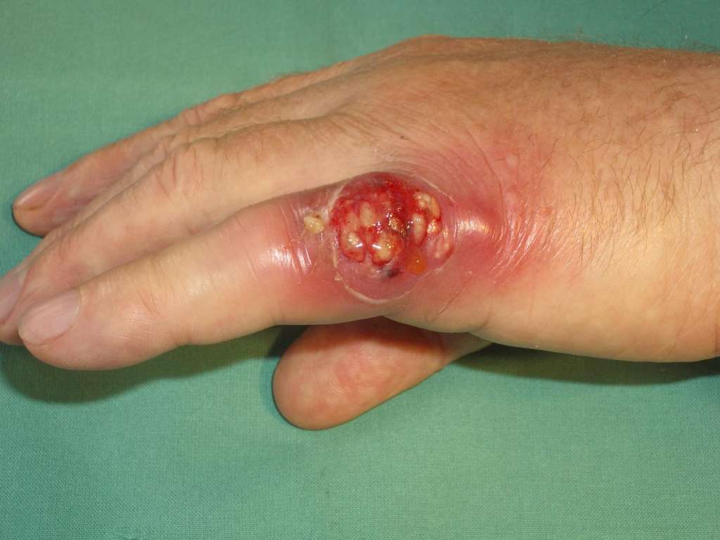 Абсцедирующий фурункул V пальца левой кисти