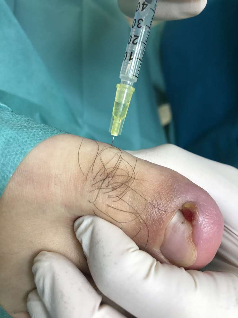 Обезболивание по Обернут - Лукашевичу Анестезия на пальце Обезболивание при вросшем ногте