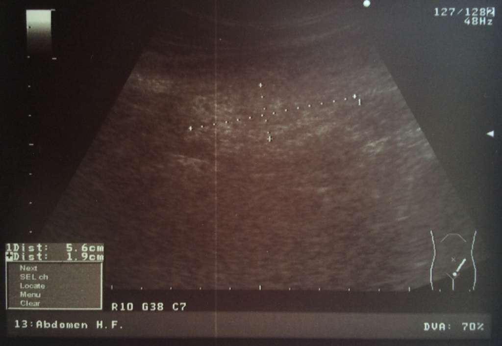 УЗИ эпиплоит