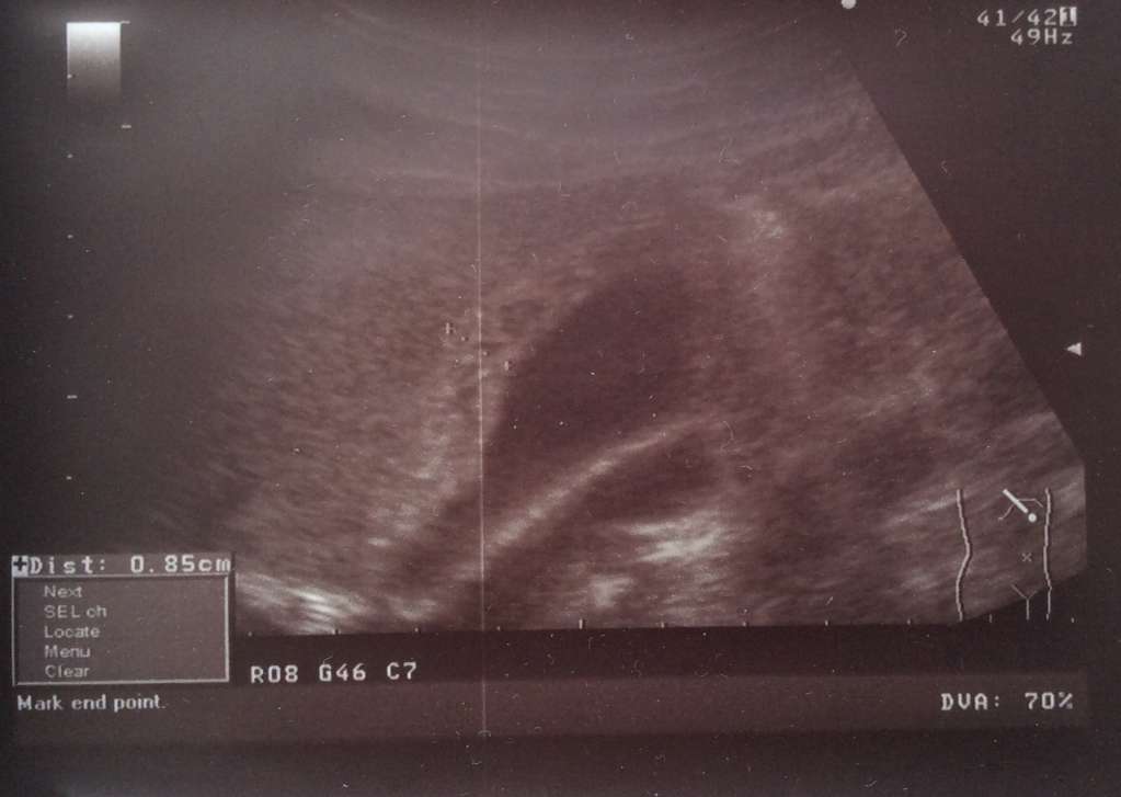 Бескаменный холецистит