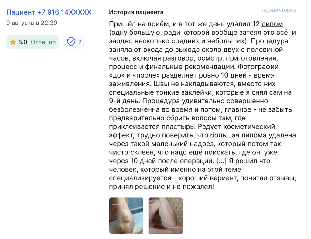 Отзыв об удалении липом при лимоатозе. Множественные липомы при липоматозе. Врач хирург Гармаев Александр Шагжиевич