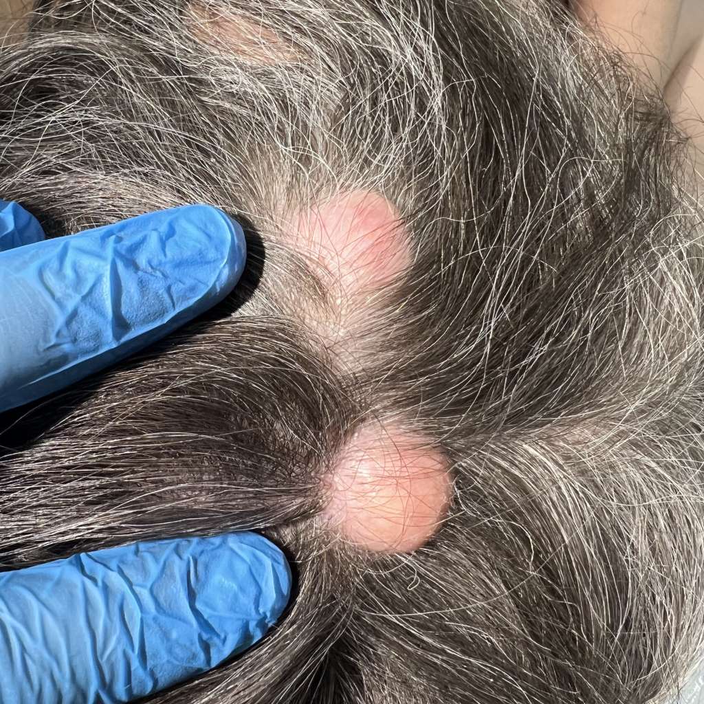 Атеромы волосистой части головы доктор Гармаев удаление атером в москве