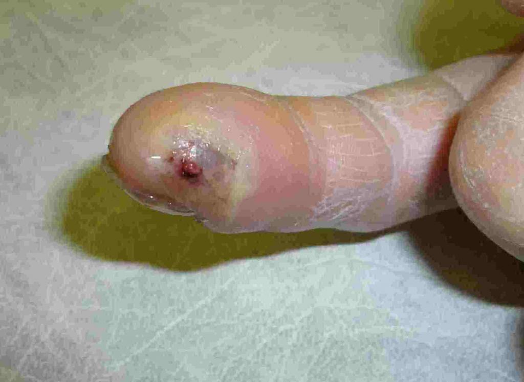 Granuloma piogénico dedo Granuloma piogénico dedo