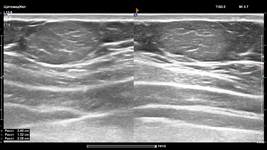 Ультразвуковая картина липомы. 